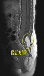 脊髄脂肪腫