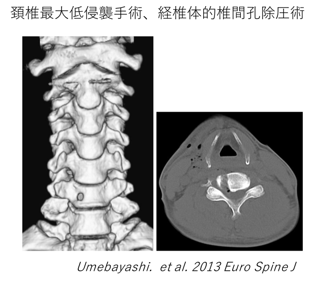 頸椎最大低侵襲手術、経椎体的椎間孔除圧術