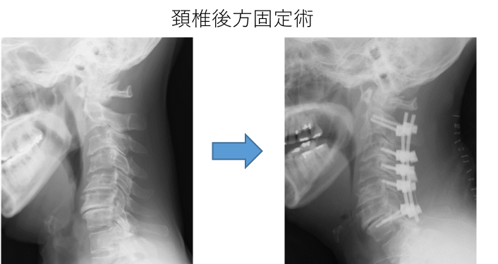 頸椎後方固定術