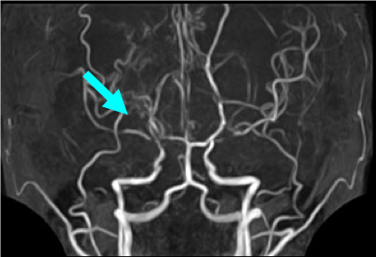 術前のMRA画像です。矢印の部位で動脈が狭窄、閉塞しています。