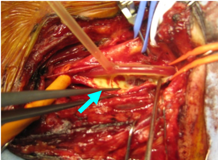 図2　頚動脈を切開したところの術中写真です。矢印の部位に頚動脈内腔のプラークが認められます。