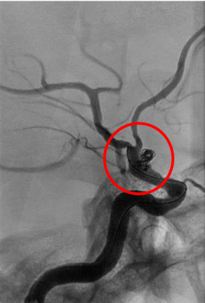 術後の造影写真です。主幹動脈は温存できており、動脈瘤は造影されなくなっています。