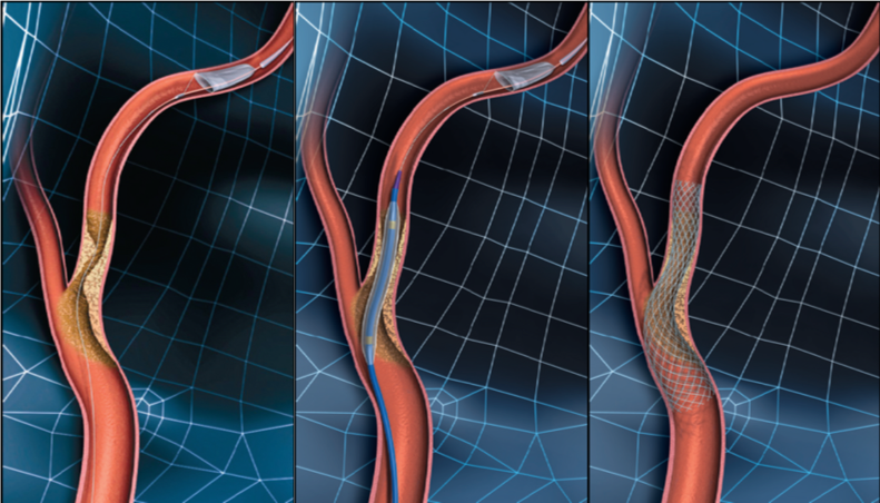 図4-6　頚動脈ステント留置術のイラスト図です。