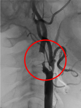 術前の頚動脈造影写真です。〇内に頚動脈狭窄が見られます。