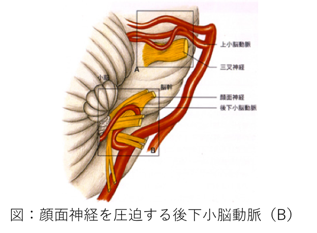図　顔面神経を圧迫する後下小脳動脈（B）