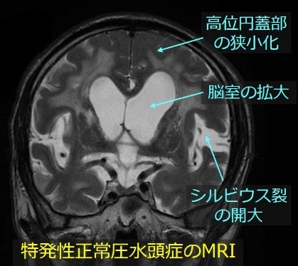図1　三叉神経を圧迫する上小脳動脈